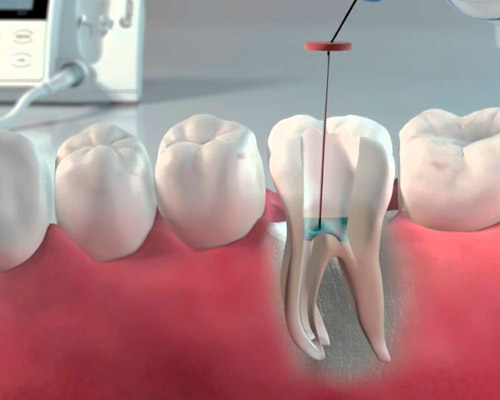 endodontia03